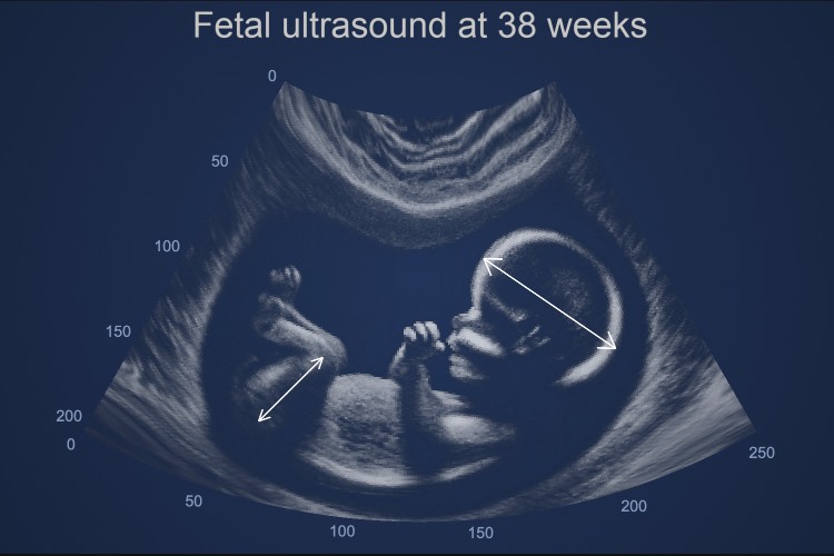 Angular Polar Ultrasound Heatmap | JavaScript Charts | SciChart.js | SciChart.js Demo