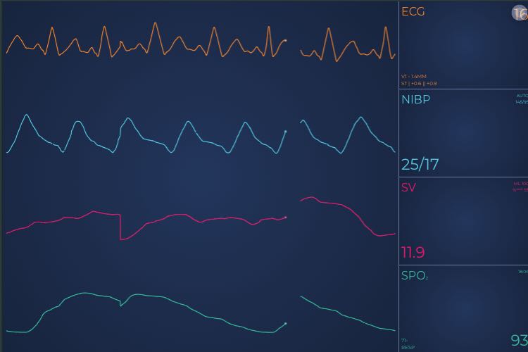 Angular Vital Signs ECG/EKG Medical Demo | SciChart.js Demo